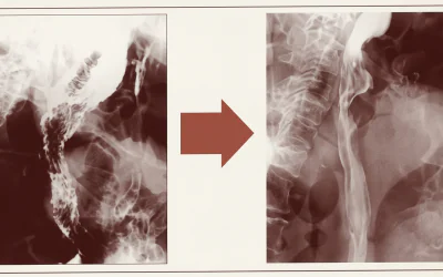 Cancer de l&rsquo;Œsophage : Tumeur de 10 cm Disparue